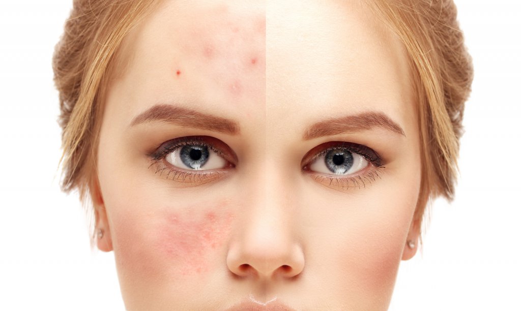 تأثیر هیرویت هلث اید بر پوست صورت