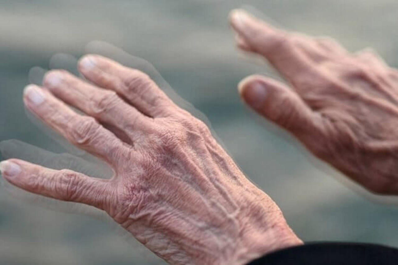 بیماری پارکینسون (PD) چیست؟