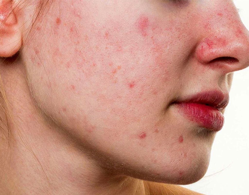 درمان جوش و منافذ باز