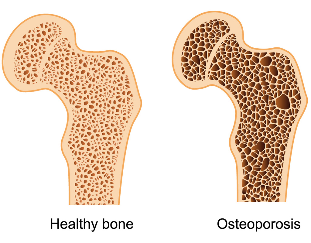 قویترین داروی پوکی استخوان